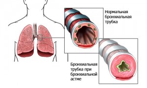 Бронхіальна астма: лікування народними засобами