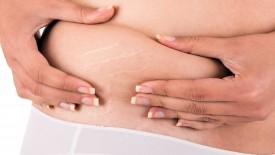 Чи можна позбутися від розтяжок після вагітності?