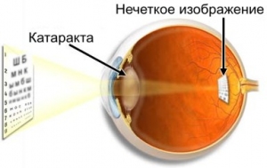 Катаракта ока: симптоми і лікування