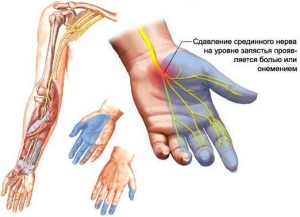 Оніміння пальців рук і ніг: симптоми, причини і лікування