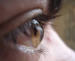 Лікування кератоконуса очі в домашніх умовах
