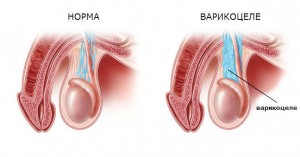 Варикоцеле: лікування без операції