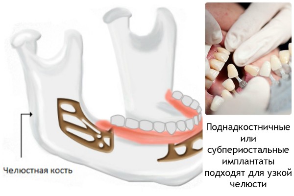 Зубні імплантати та їх типи