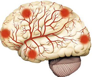 Системне захворювання мозку: діагностика, лікування, рекомендації