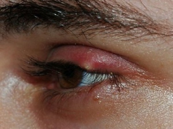 Якими ліками лікують ячмінь на оці