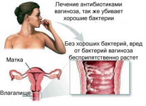 Бактеріальний вагіноз: причини, симптоми і лікування
