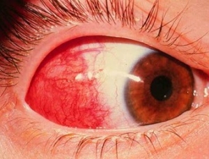 Склерит очі: симптоми і лікування