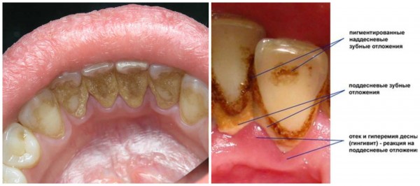 Зубний камінь – причини появи, лікування та профілактика
