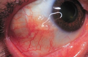 Склерит очі: симптоми і лікування