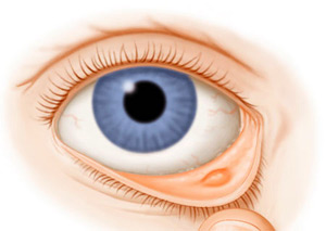 Як і чим лікувати ячмінь під оком і всередині його