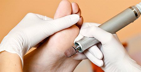 Ефективне лікування мозолів на пальцях ніг