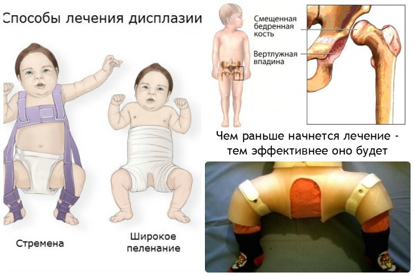Як вчасно розпізнати і вилікувати дисплазію кульшового суглоба у дітей