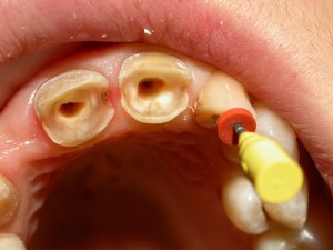 Нарощування зубів — секрети і особливості
