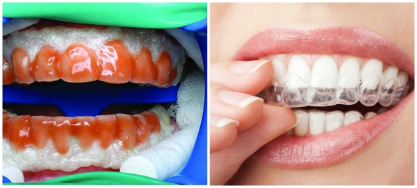 Відбілювання зубів: плюси і мінуси процедур