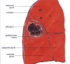 Абсцес легені: причини симптоми і лікування