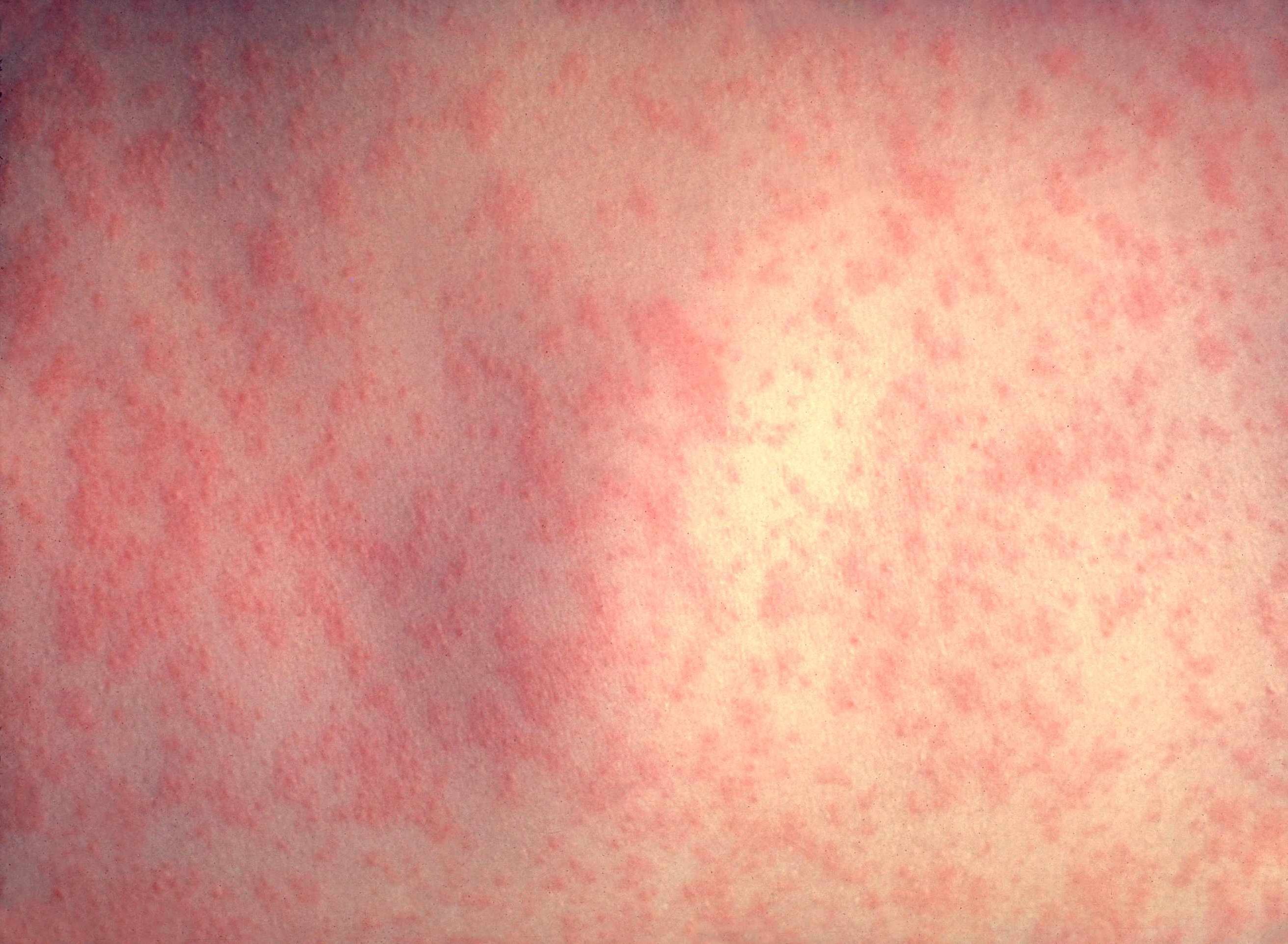Алергія на холод — симптоми і лікування захворювання
