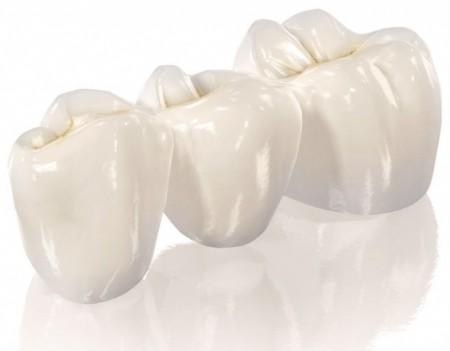 Що таке протезування зубів?