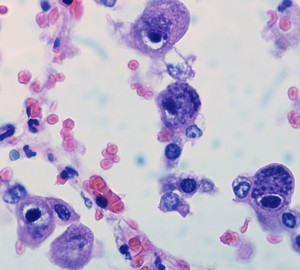 Що таке цитомегаловірус і чим він небезпечний?