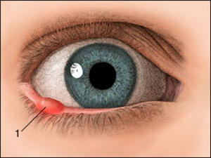 Як і чим лікувати ячмінь під оком і всередині його
