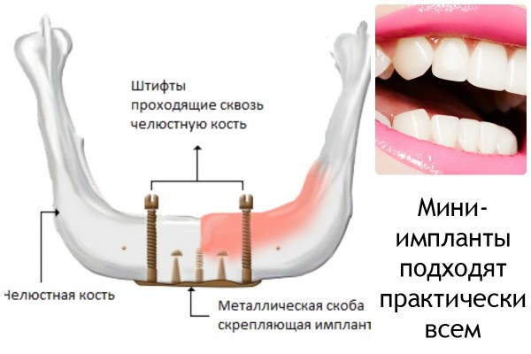 Зубні імплантати та їх типи