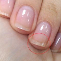 Шаруються нігті — чого не вистачає в організмі?
