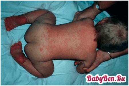 Дитячий дерматит: причини і лікування