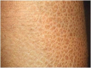 Іхтіоз шкіри: причини появи, типи хвороби, лікування
