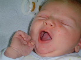 Причини і лікування висипу на обличчі у новонародженого