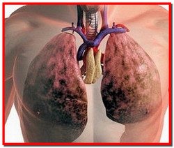 Емфізема легень. Симптоми, лікування народними засобами