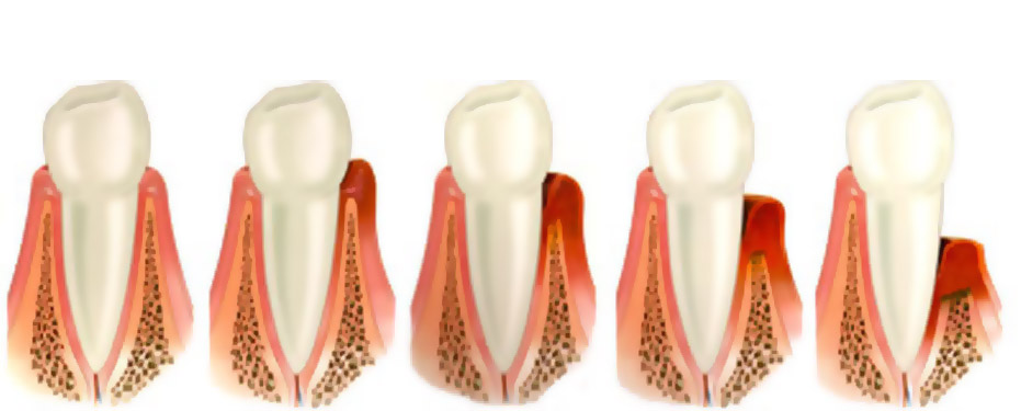 Народне лікування пародонтозу зубів і ясен