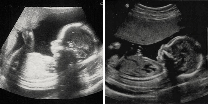 21 тиждень вагітності: що відбувається з малюком і УЗД плоду