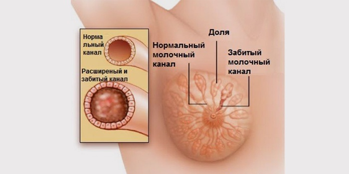 Лактостаз у годуючої матері: симптоми і лікування застою молока в грудях