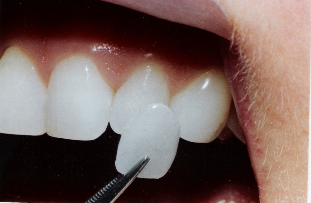 Що таке вініри — плюси і мінуси винирования зубів