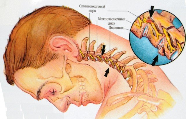 Як зняти головні болі при остеохондрозі шийного відділу?