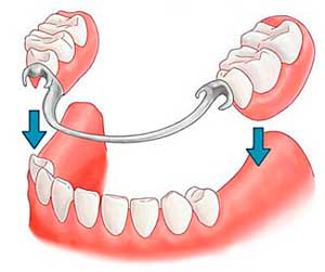 Основні види зубного протезування та їх характеристики