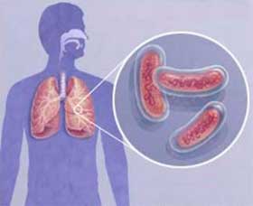 Туберкульоз, інфекційна небезпека для всіх оточуючих