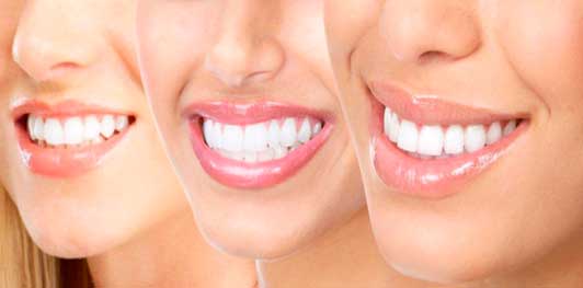 Відбілювання зубів заради голлівудської посмішки: за і проти. Розповідає лікар стоматолог