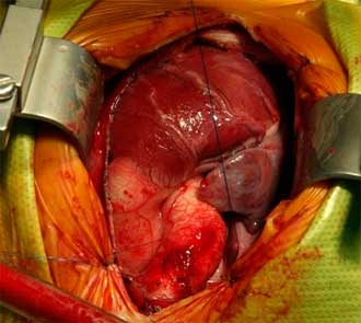 Операції на серці в Ізраїлі: особливості і методики проведення