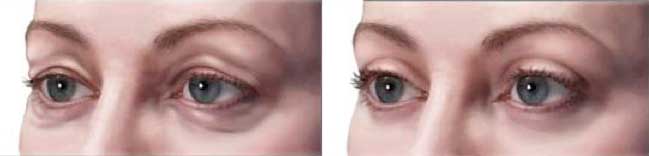 Особливості пластичних операцій на повіках очей