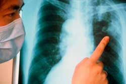 Туберкульоз — хвороба як відображення. Рання стадія туберкульозу — кашель.