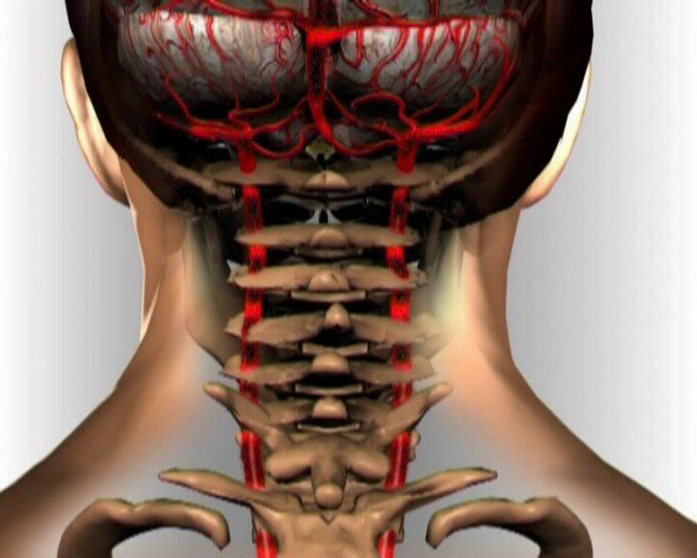 Порушення мозкового кровообігу при шийному остеохондрозі: причини, симптоми, лікування