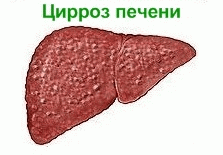 Асцит в черевній порожнині – рідина в животі. Асцит при цирозі печінки як головна причина його розвитку. Водянка живота