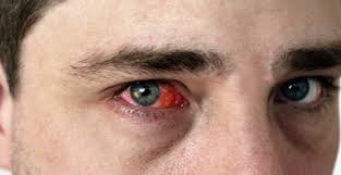 Крововилив в оці: що робити? Причини та способи лікування