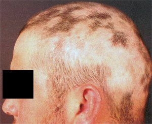 Волосся випадає з білим кінчиком: причини і що робити?