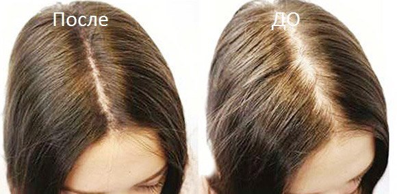 Апарат Дарсонваль для волосся: для росту волосся і від випадіння
