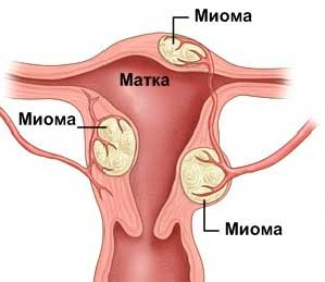 Науковий прорив в лікуванні міоми матки — препарат Эсмия компанії Гедеон Ріхтер.
