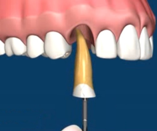 Історичні факти видалення зубів, коли не можна їх видаляти. І що робити з зубом мудрості.