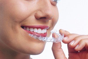 Відбілювання зубів платівкою — застосування капи