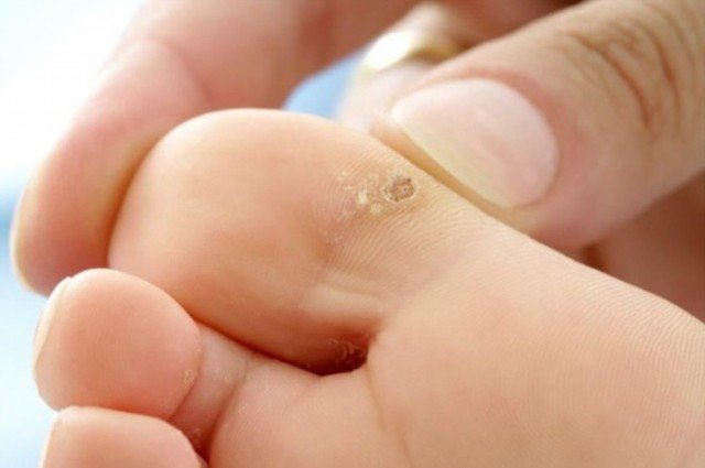Як позбутися мозолів на пальцях ніг: ефективні методи