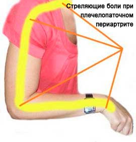 Плечолопатковий періартрит плечового суглоба — запалення сухожиль плеча. Причини, лікування, стадії, лікувальна гімнастика.